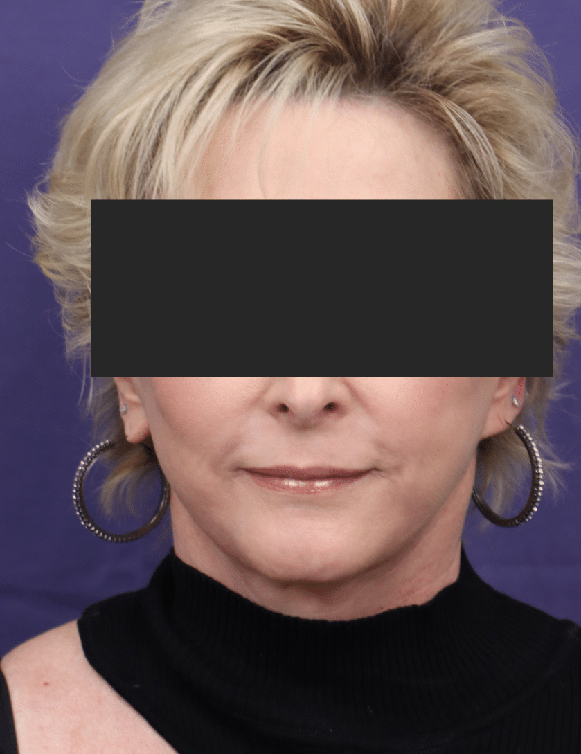 After Image: Face & Neck lift,  Upper & Lower Blepharoplasty, Facial Fat Grafting - front