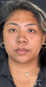 After Image: Masseter Toxin for Facial Slimming