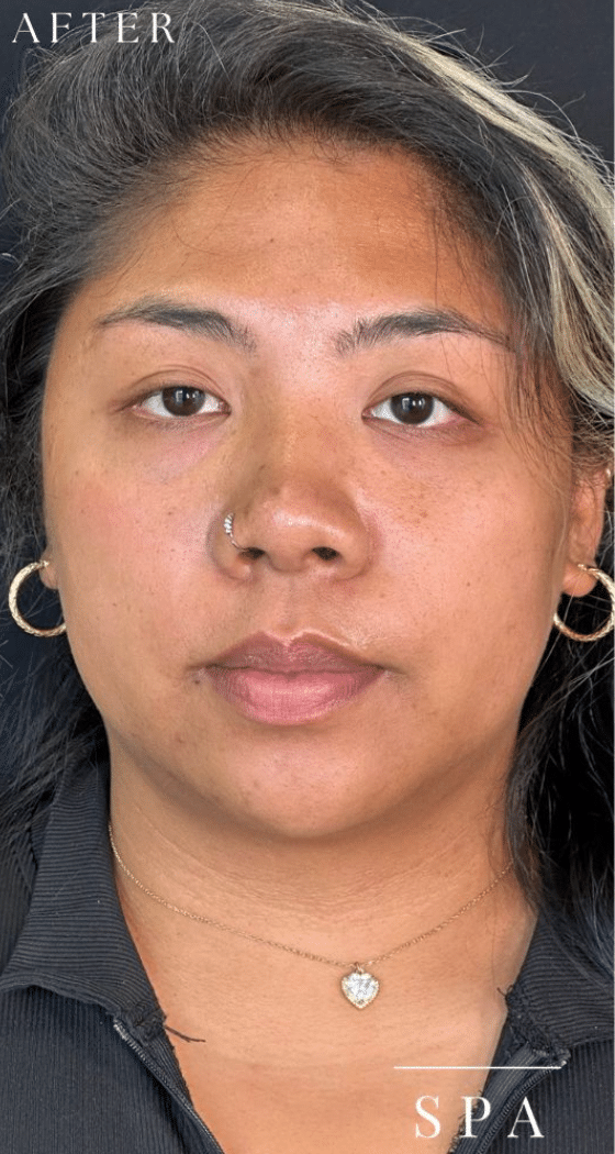 After Image: Masseter Toxin for Facial Slimming - front