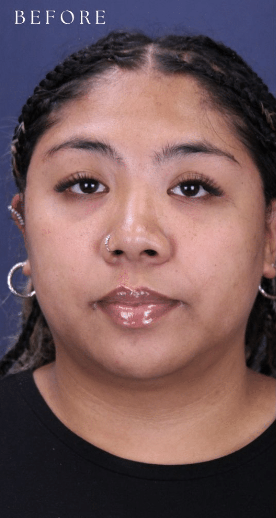 Before Image: Masseter Toxin for Facial Slimming - front
