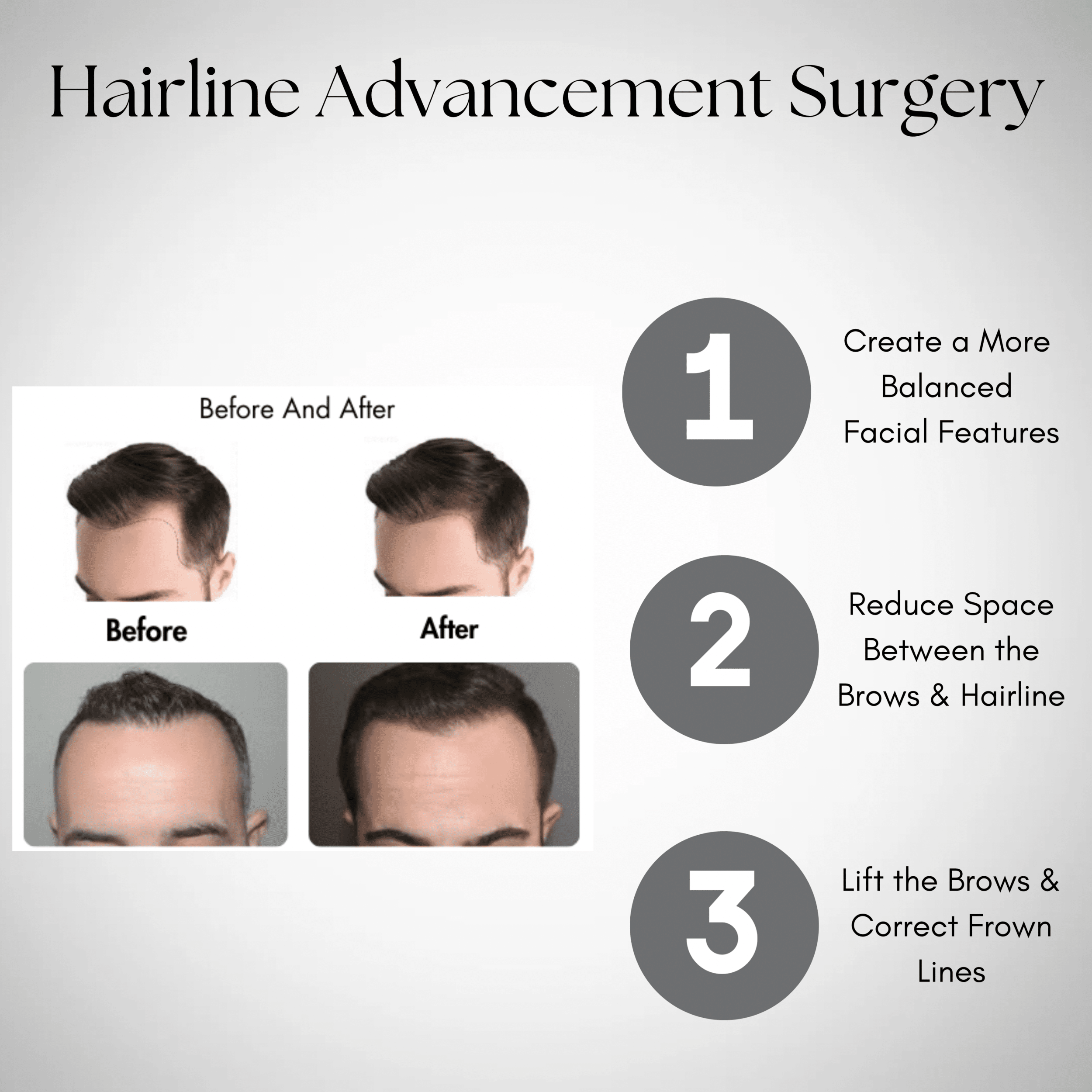 BENEFITS OF FOREHEAD REDUCTION SURGERY - 2 BENEFITS OF FOREHEAD REDUCTION SURGERY - 2